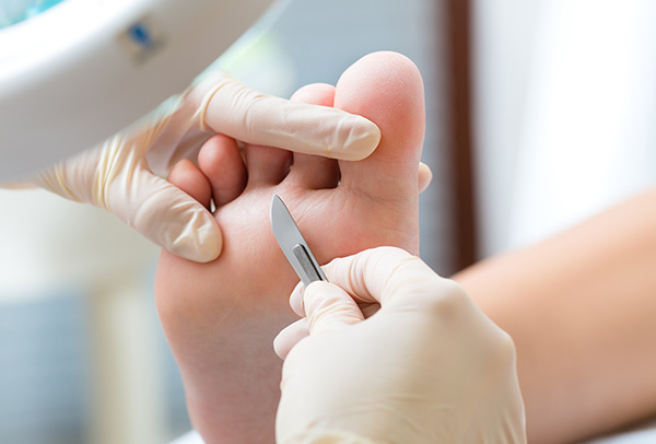 Removal of dry skin from foot