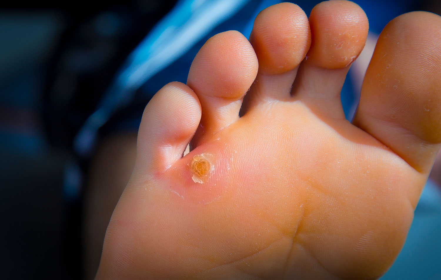 Corn on Foot