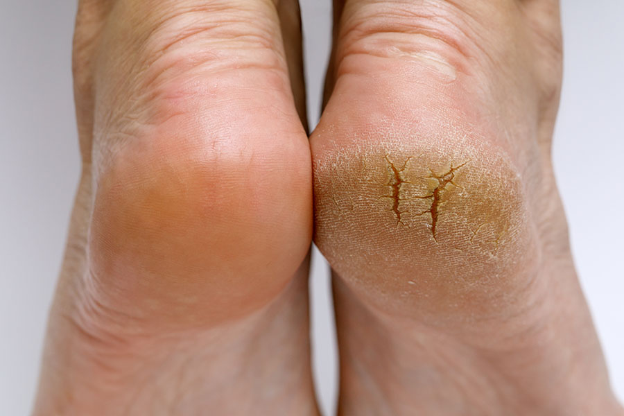 Cracked Heels